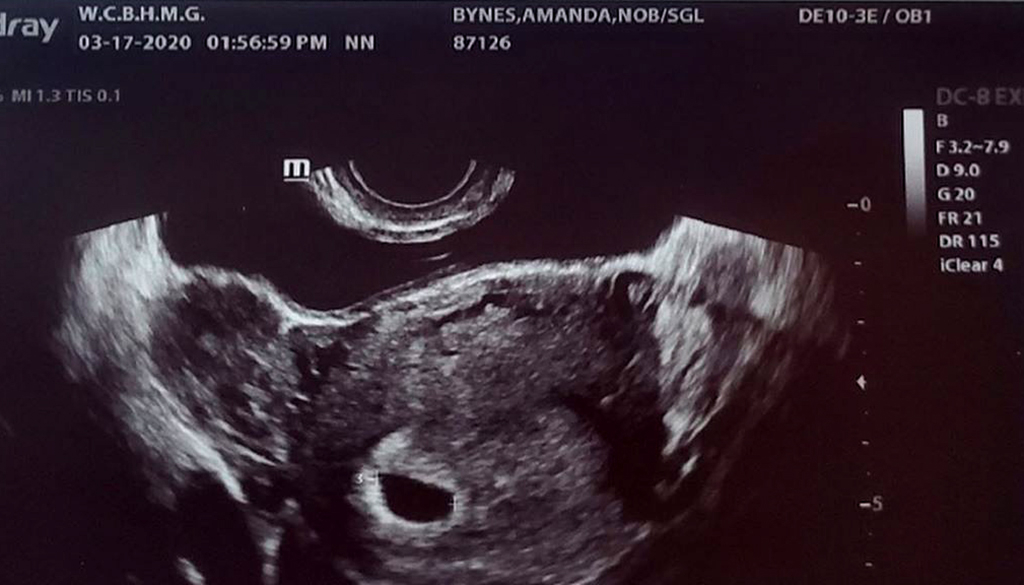 Image result for amanda bynes ultrasound